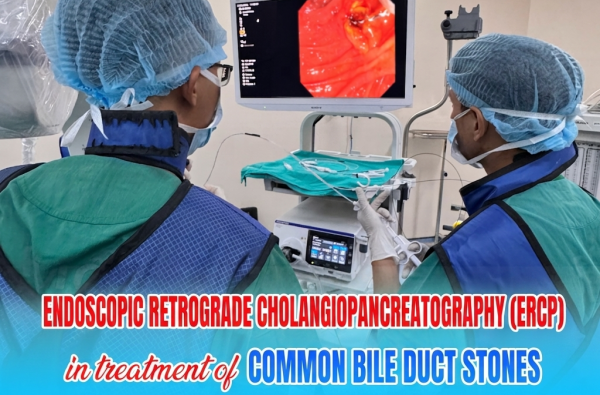SUCCESSFUL TREATMENT OF A COMMON BILE DUCT STONE USING ENDOSCOPIC RETROGRADE CHOLANGIOPANCREATOGRAPHY (ERCP)