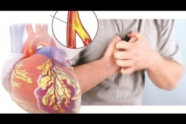 Xơ vữa động mạch: Nhận biết và cách điều trị bệnh