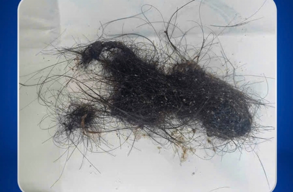 PHÁT HIỆN DỊ VẬT BÚI TÓC LỚN TRONG DẠ DÀY BÉ GÁI 6 TUỔI 