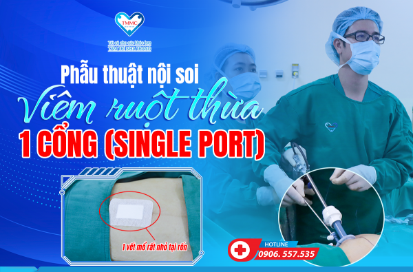 PHẪU THUẬT NỘI SOI RUỘT THỪA 1 CỔNG (SINGLE PORT) – BƯỚC TIẾN MỚI TRONG ĐIỀU TRỊ TẠI BVĐK TÂM TRÍ NHA TRANG