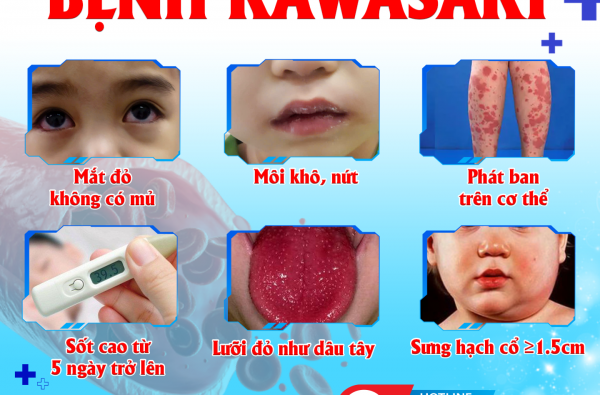 BỆNH KAWASAKI Ở TRẺ EM – ĐỪNG CHỦ QUAN KHI TRẺ SỐT CAO KÉO DÀI