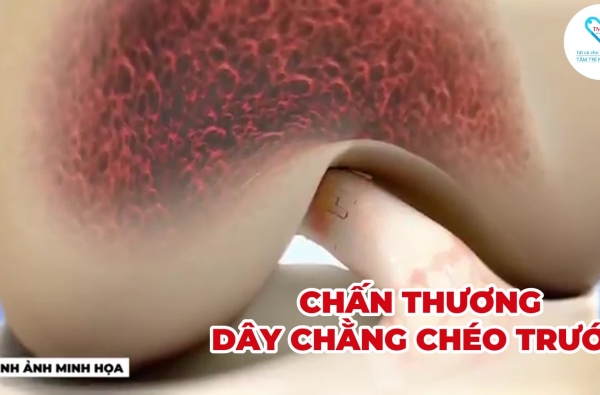 ĐỨT DÂY CHẰNG CHÉO TRƯỚC – CÓ CẦN PHẪU THUẬT KHÔNG?