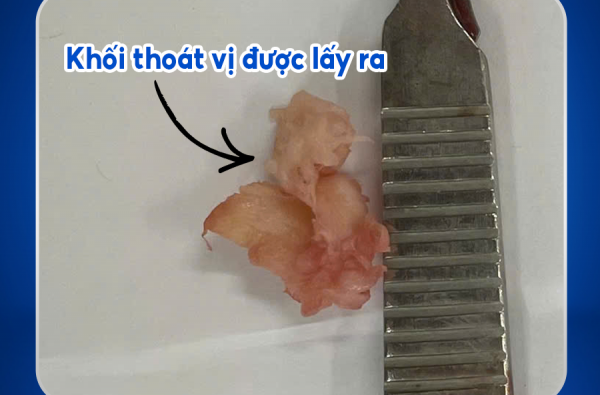 GIẢI THOÁT CƠN ĐAU CỘT SỐNG BẰNG PHẪU THUẬT NỘI SOI HAI CỔNG