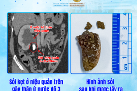XỬ LÝ THÀNH CÔNG SỎI NIỆU QUẢN LỚN – CHẤM DỨT CƠN ĐAU ÂM Ỉ KÉO DÀI”
