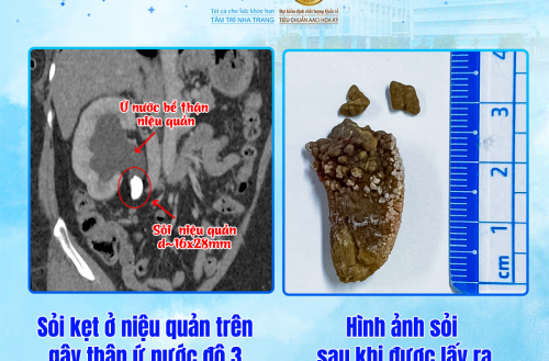 XỬ LÝ THÀNH CÔNG SỎI NIỆU QUẢN LỚN – CHẤM DỨT CƠN ĐAU ÂM Ỉ KÉO DÀI”