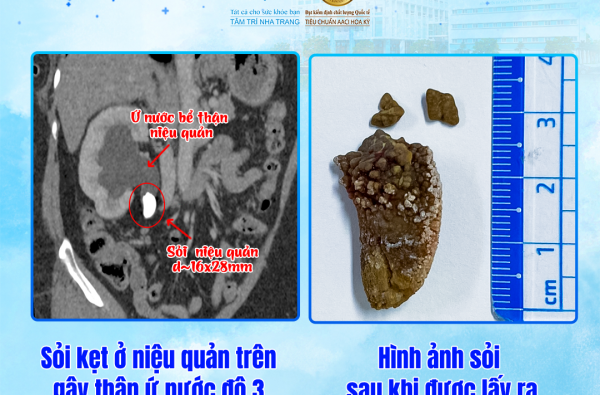 XỬ LÝ THÀNH CÔNG SỎI NIỆU QUẢN LỚN – CHẤM DỨT CƠN ĐAU ÂM Ỉ KÉO DÀI”