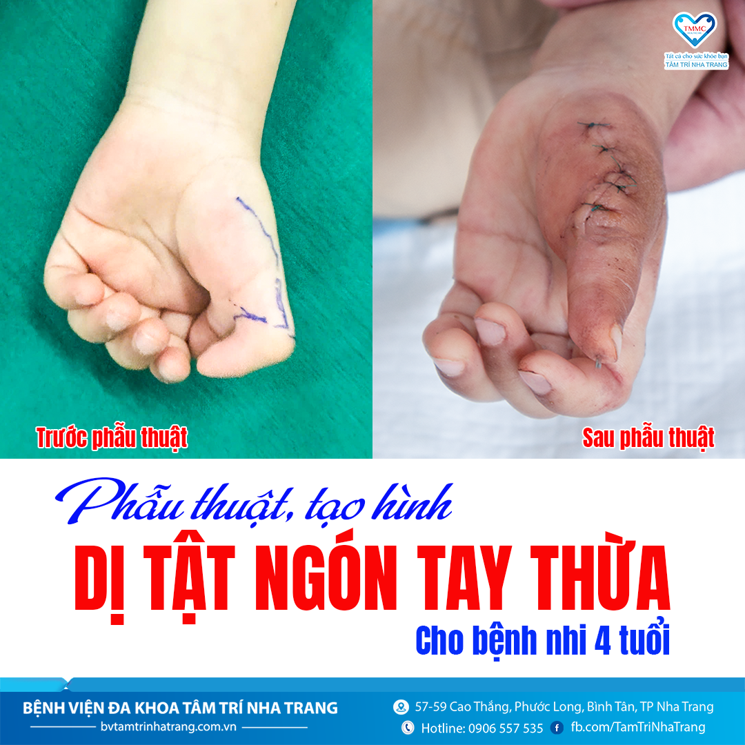 05.2025_PHYU_THUYT_NGON_TAY_THYA