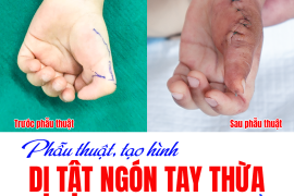 PHẪU THUẬT TẠO HÌNH DỊ TẬT NGÓN TAY THỪA