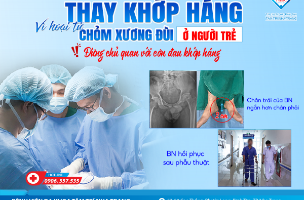 THAY KHỚP HÁNG VÌ HOẠI TỬ CHỎM XƯƠNG ĐÙI Ở NGƯỜI TRẺ – Đừng chủ quan với cơn đau khớp háng