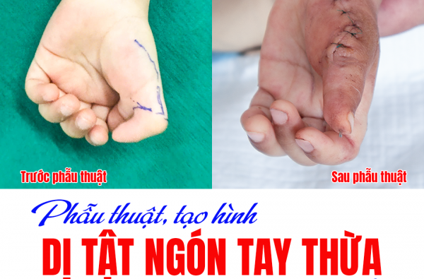 PHẪU THUẬT TẠO HÌNH DỊ TẬT NGÓN TAY THỪA