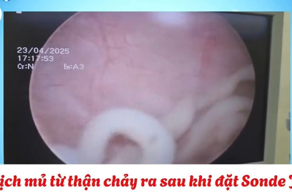 ĐẶT SONDE JJ – XỬ LÝ KỊP THỜI TẮC NGHẼN NIỆU QUẢN