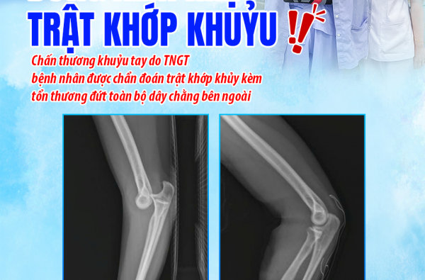 ĐỪNG XEM NHẸ TRẬT KHỚP KHUỶU
