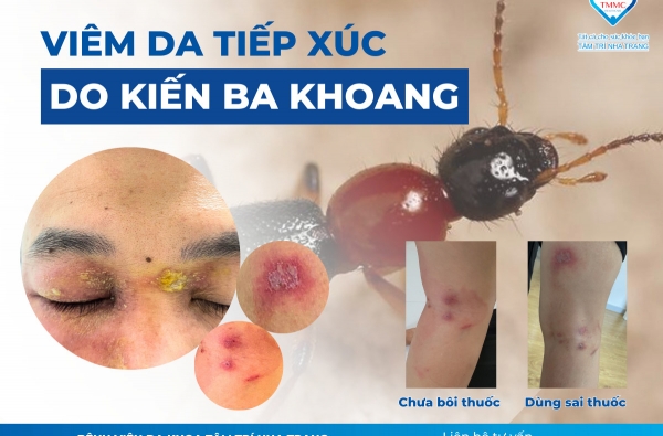 VIÊM DA DO KIẾN BA KHOANG