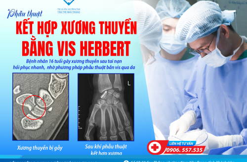 PHẪU THUẬT KẾT HỢP XƯƠNG THUYỀN BẰNG VIS HERBERT - ÍT XÂM LẤN - PHỤC HỒI NHANH