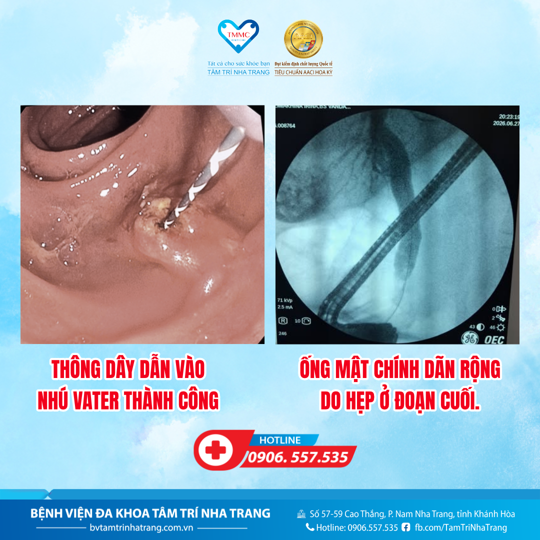 CA_ERCP_2
