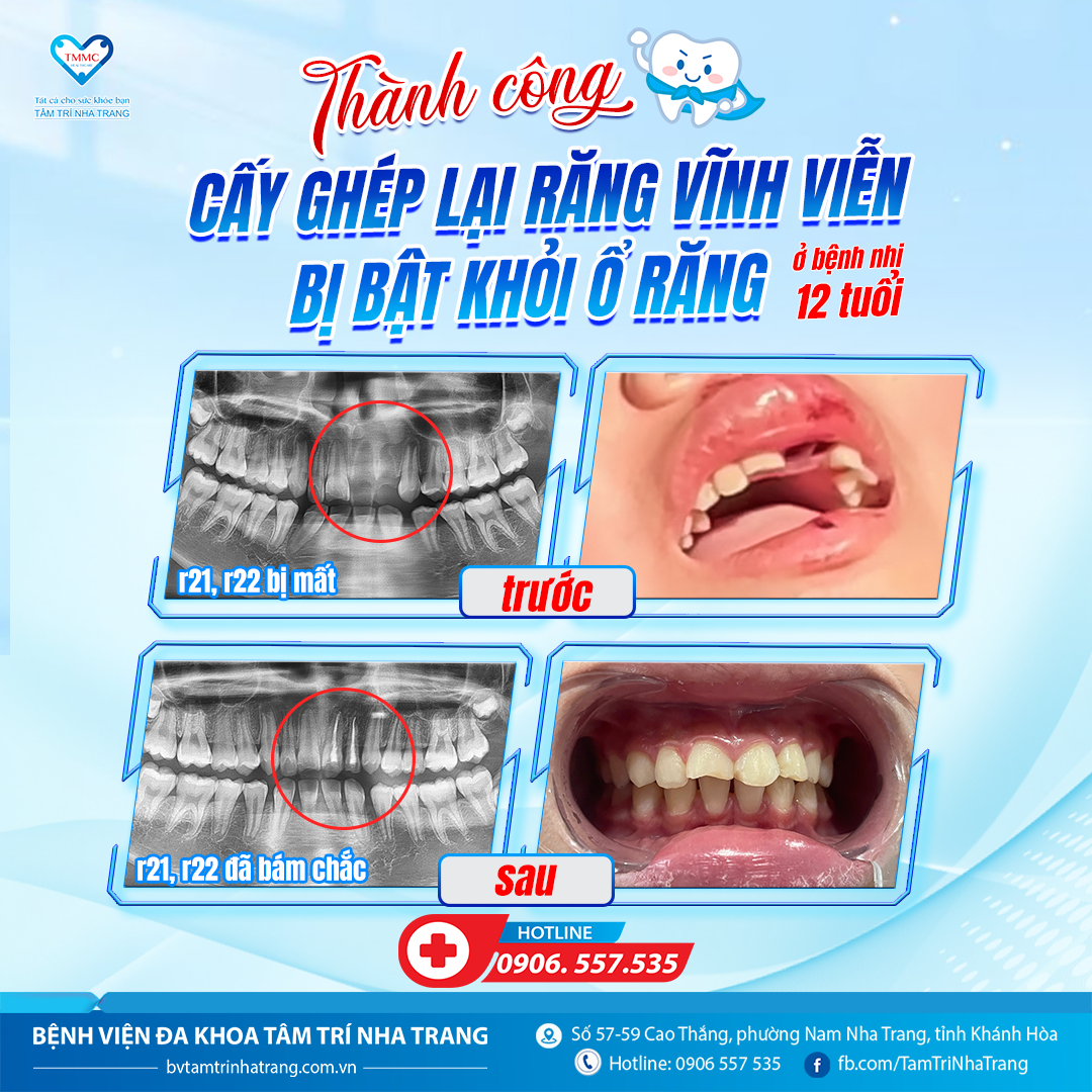 CA_CYY_RYNG