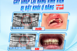 THÀNH CÔNG CẤY GHÉP LẠI RĂNG VĨNH VIỄN BỊ BẬT KHỎI Ổ RĂNG Ở BÊNH NHI 12 TUỔI