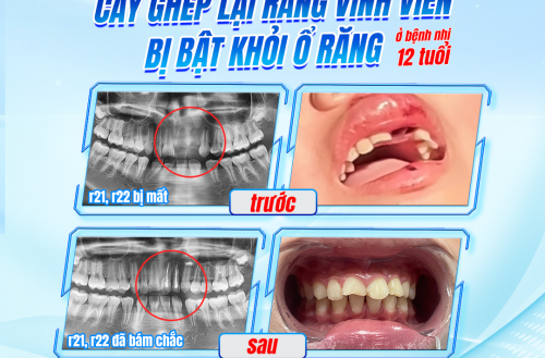 THÀNH CÔNG CẤY GHÉP LẠI RĂNG VĨNH VIỄN BỊ BẬT KHỎI Ổ RĂNG Ở BÊNH NHI 12 TUỔI