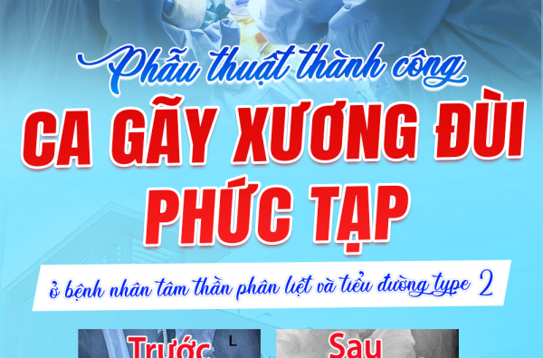 PHẪU THUẬT THÀNH CÔNG CA GÃY XƯƠNG ĐÙI PHỨC TẠP Ở BỆNH NHÂN TÂM THẦN PHÂN LIỆT VÀ ĐÁI THÁO ĐƯỜNG TYPE 2