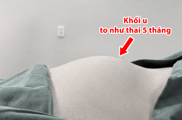 BỤNG TO BẤT THƯỜNG NHƯNG CHỦ QUAN KHÔNG ĐI KHÁM: CÔ GÁI 20 TUỔI PHÁT HIỆN U BUỒNG TRỨNG XOẮN