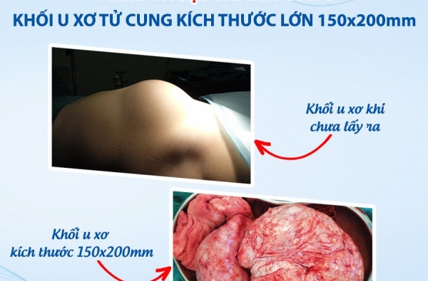 PHẪU THUẬT THÀNH CÔNG KHỐI U XƠ TỬ CUNG KÍCH THƯỚC LỚN 150X200 MM