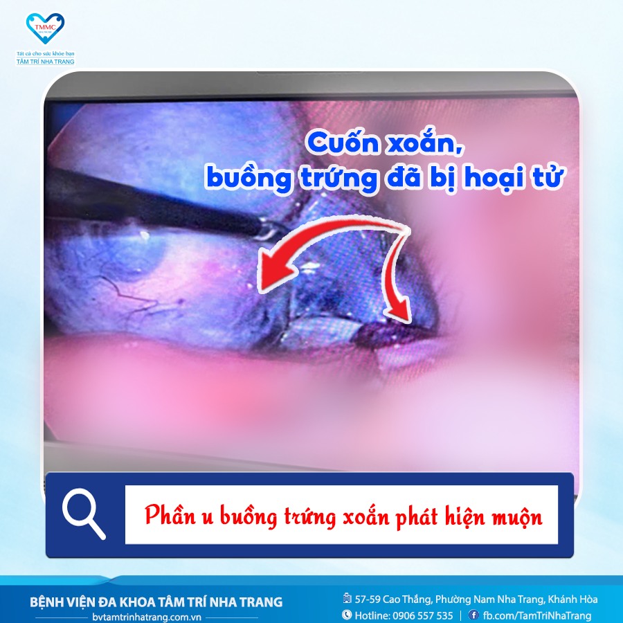 u_buYng_trYng_xoYn_1