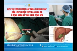 ĐIỀU TRỊ VIÊM TÚI MẬT CẤP BẰNG DẪN LƯU TÚI MẬT XUYÊN GAN QUA DA 