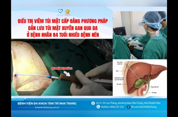 ĐIỀU TRỊ VIÊM TÚI MẬT CẤP BẰNG DẪN LƯU TÚI MẬT XUYÊN GAN QUA DA 