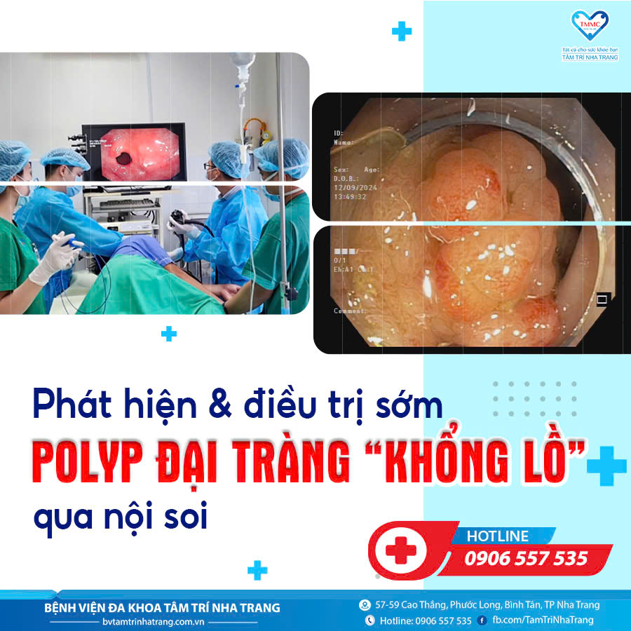 polyp_YYi_trang_qua_nYi_soi