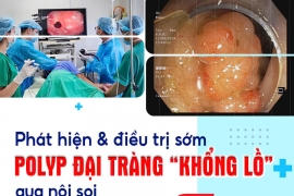 PHÁT HIỆN VÀ ĐIỀU TRỊ SỚM POLYP ĐẠI TRÀNG “KHỔNG LỒ” QUA NỘI SOI