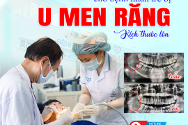 GIỮ LẠI KHUÔN MẶT CHO BỆNH NHÂN TRẺ MẮC U NGUYÊN BÀO MEN KÍCH THƯỚC LỚN