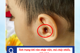 VIÊM TAI GIỮA - KHI CHỦ QUAN CÓ THỂ TRẢ GIÁ ĐẮT