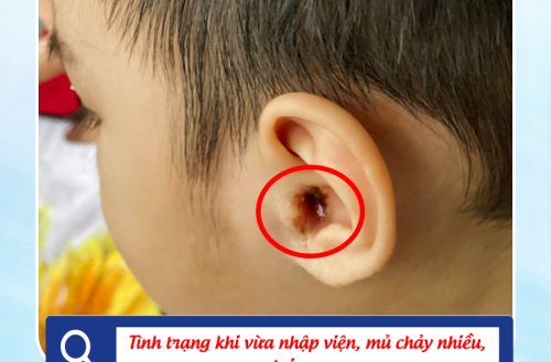 VIÊM TAI GIỮA - KHI CHỦ QUAN CÓ THỂ TRẢ GIÁ ĐẮT