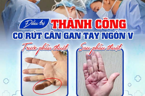 ĐIỀU TRỊ THÀNH CÔNG TRƯỜNG HỢP CO RÚT CÂN GAN TAY NGÓN V