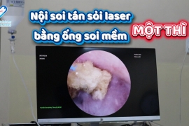 NỘI SOI TÁN SỎI THẬN BẰNG ỐNG SOI MỀM MỘT THÌ